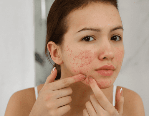 I have acne, is dermaplaning the right treatment for me?